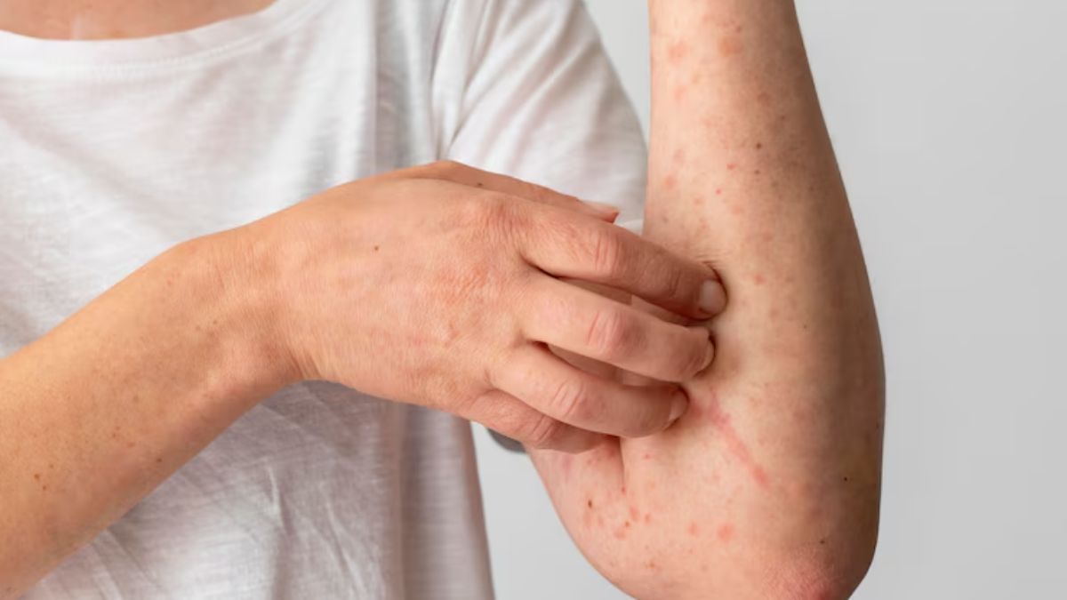 Measles outbreak in US