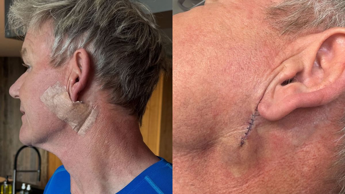 Gordon Ramsay skin cancer surgery