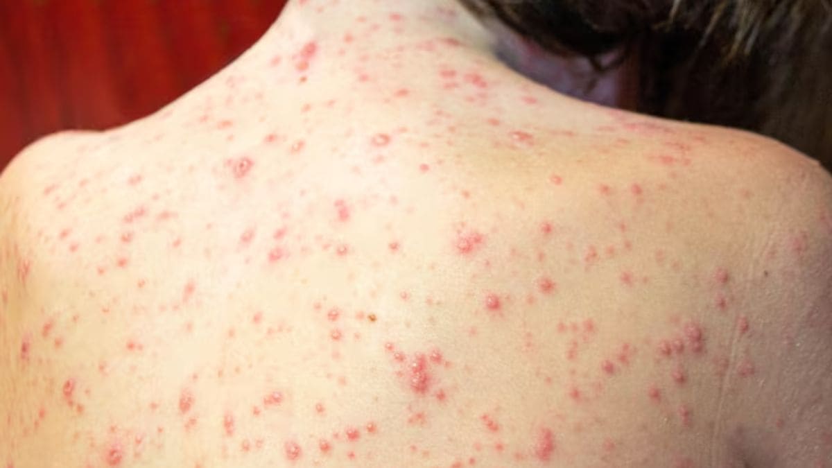 Chickenpox outbreak hits Kollam