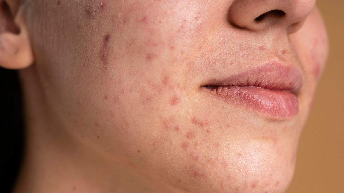 Acne flare-up? Weather-proof your skin this festive season with easy tips
